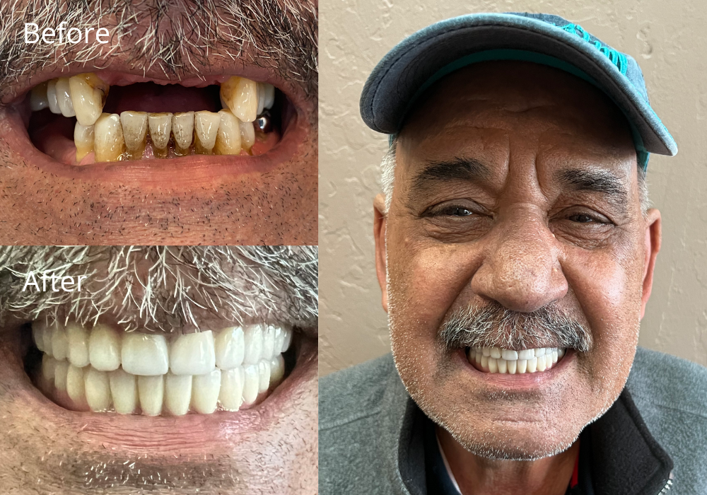 Best Dental Implant Results Scottsdale AZ