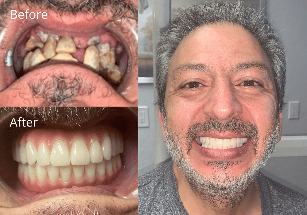 Dental Implant Results at ProSmile Dental Implant Center