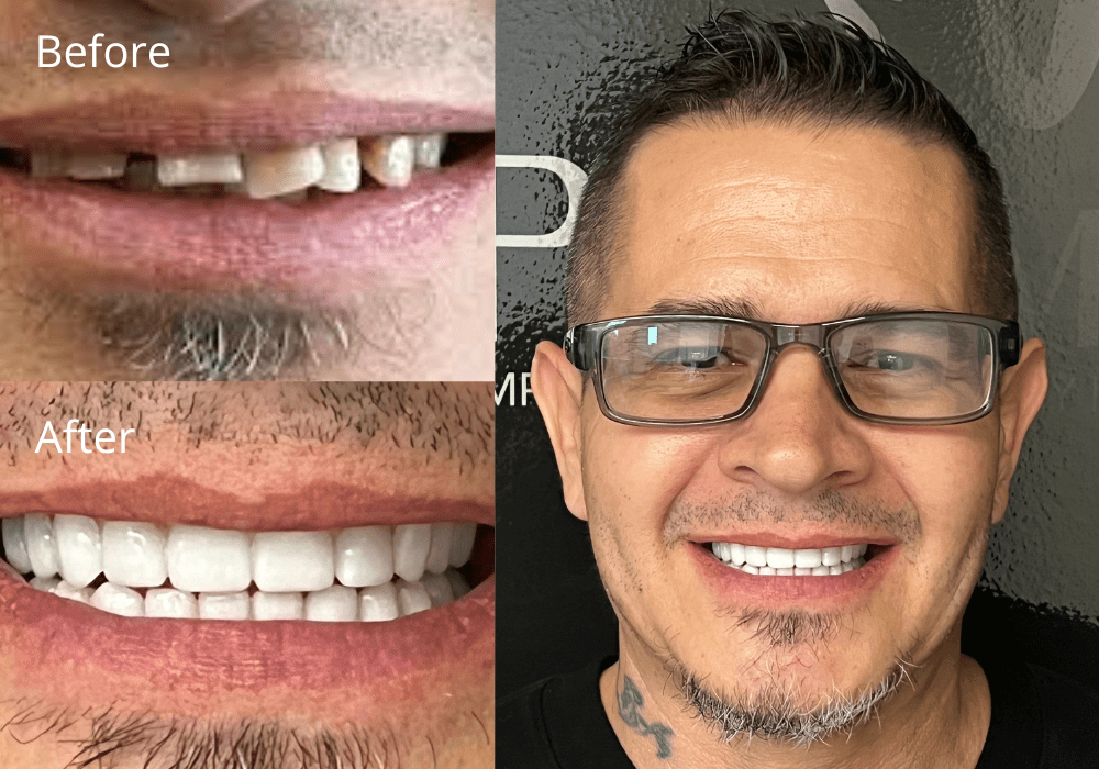 Dental Implant Results at ProSmile Dental Implant Center