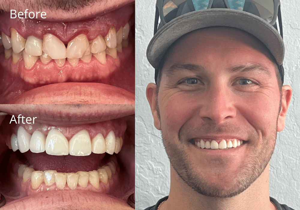 Cosmetic Dentistry Before and After at ProSmile Dental Implant Center