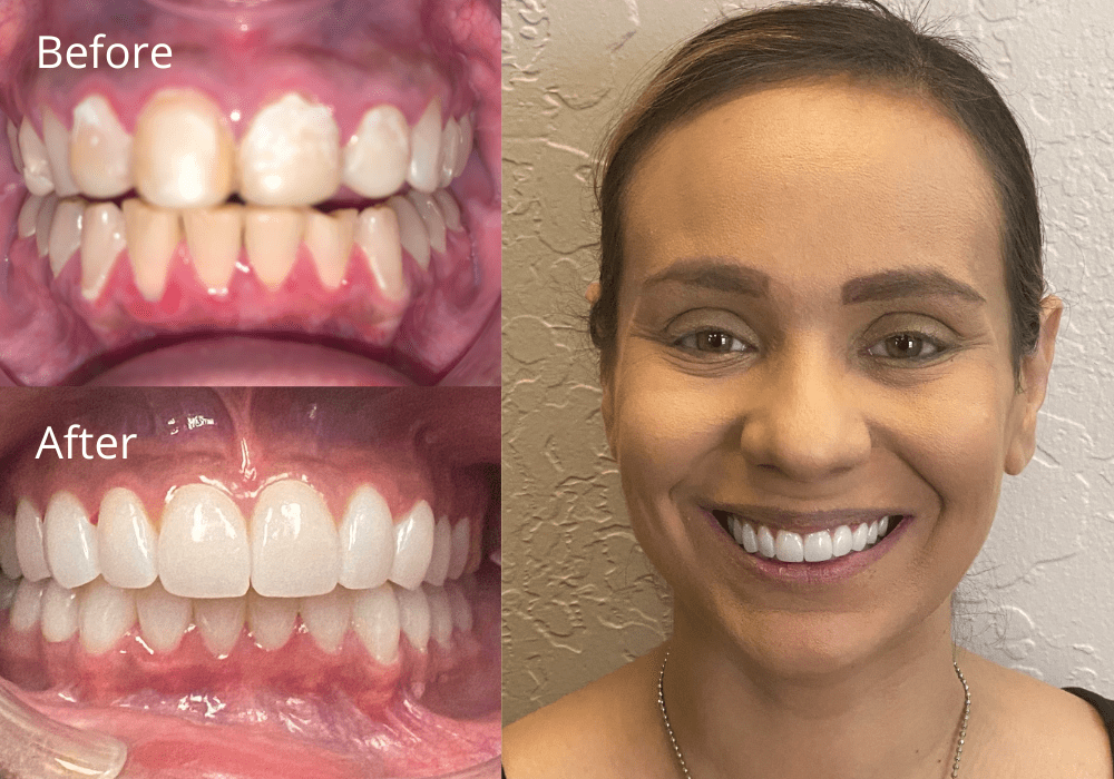 Cosmetic Dentistry Before and After at ProSmile Dental Implant Center