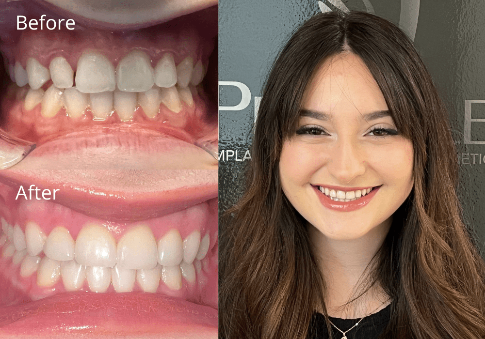 Cosmetic Dentistry Before and After at ProSmile Dental Implant Center