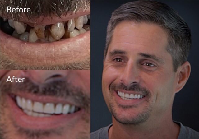 before and after of snap in denture