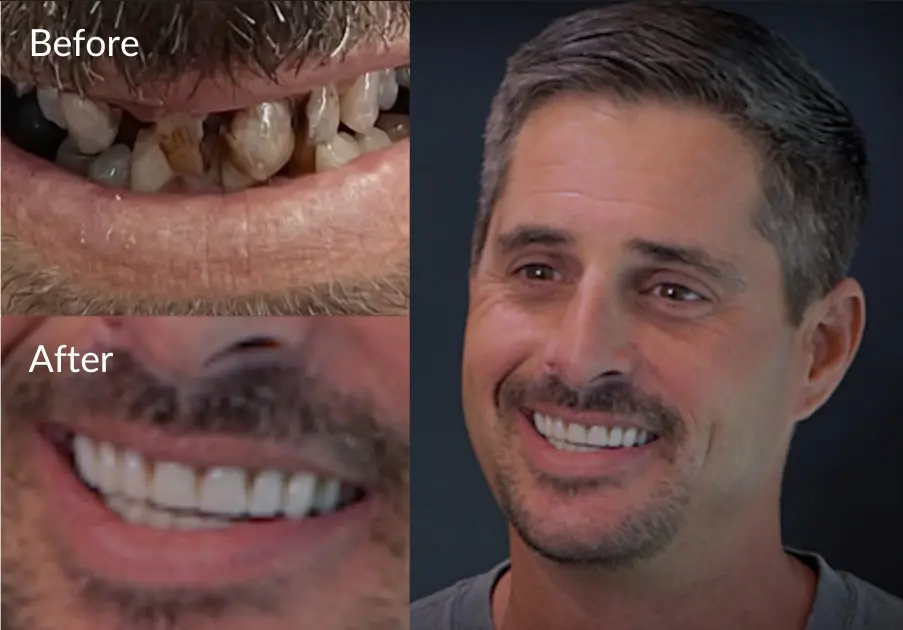 Snap in denture before and after before and after of snap in denture