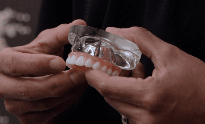 All on 4 Dental Implants Phoenix: A Game Changer for Missing Teeth All on 4 Dental Implants Phoenix: A Game Changer for Missing Teeth