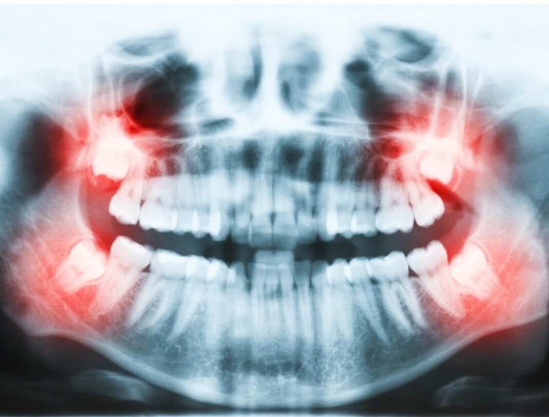 Impacted Wisdom Teeth Removal Scottsdale AZ